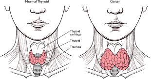 Obat Hipertiroid tanpa Operasi ada DISINI! Hipertiroid1